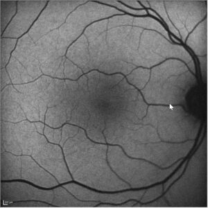 Fundus Autoflorescence