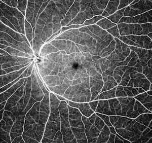Optical Coherence Tomography Angiography