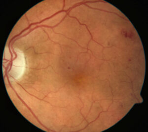 Color Fundus Photography