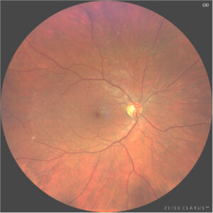 Widefield Color Fundus Photograph