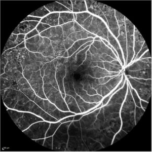 Fluorescein Angiography