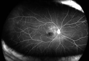 Widefield Fluorescein Angiography