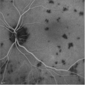 Indocyanine Green Angiography (ICGA)