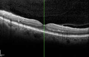Optical Coherence Tomography